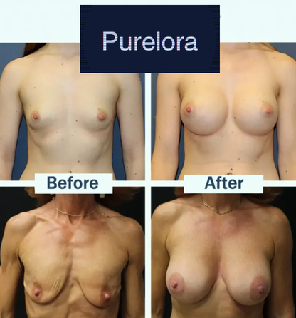 【Official Flagship Store】Purelora® Targeted Breast Enhancement Advanced Nano Microneedle Patch